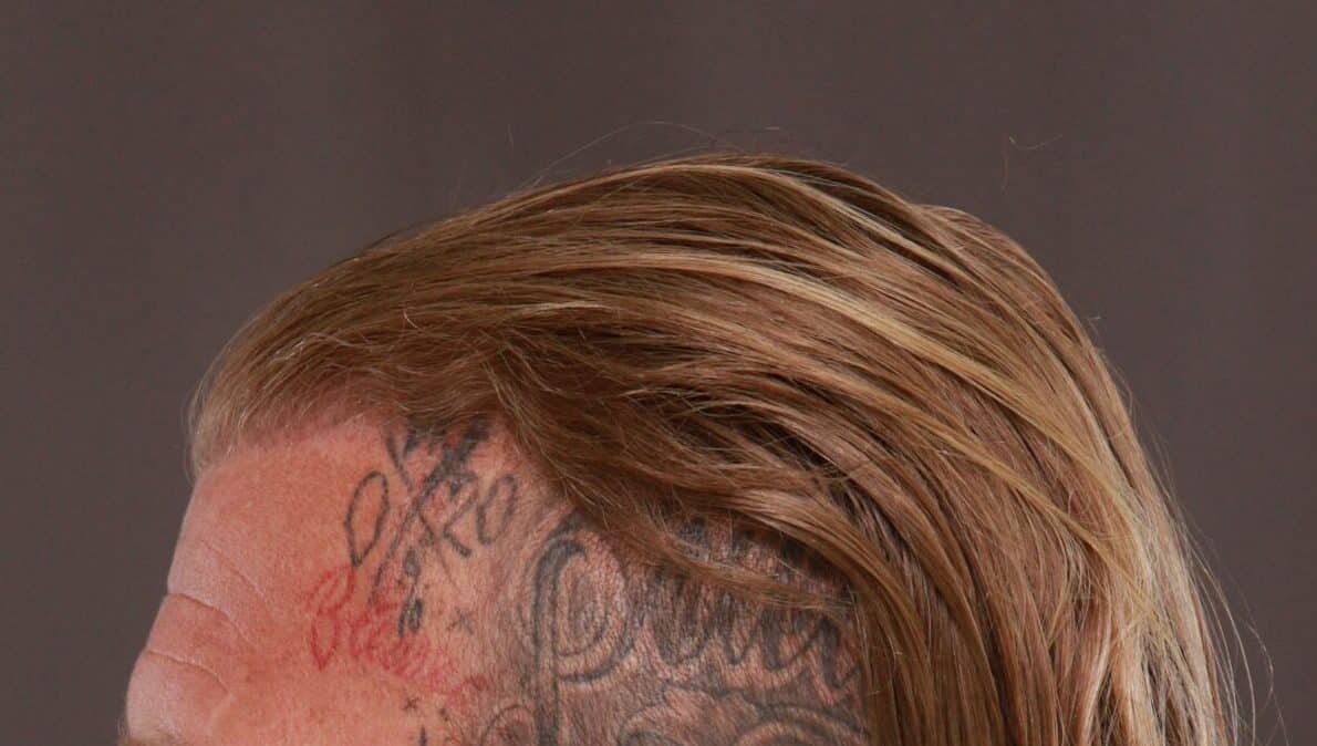 After Image: FUT Hair Transplant by Dr. Manning - left-side