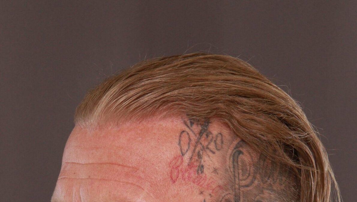 After Image: FUT Hair Transplant by Dr. Manning - left-front-oblique