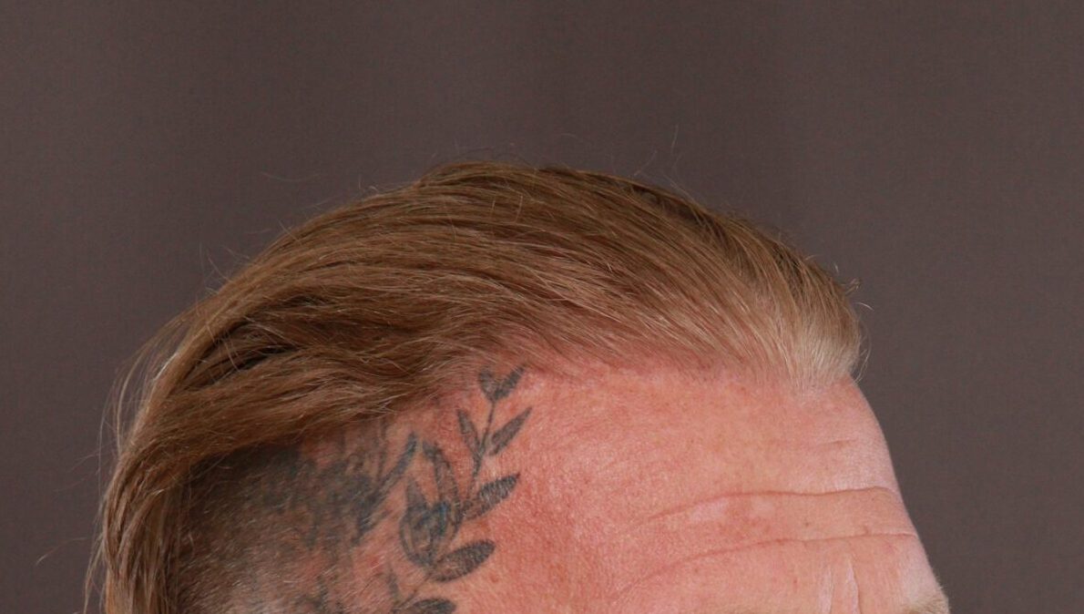 After Image: FUT Hair Transplant by Dr. Manning - right-front-oblique