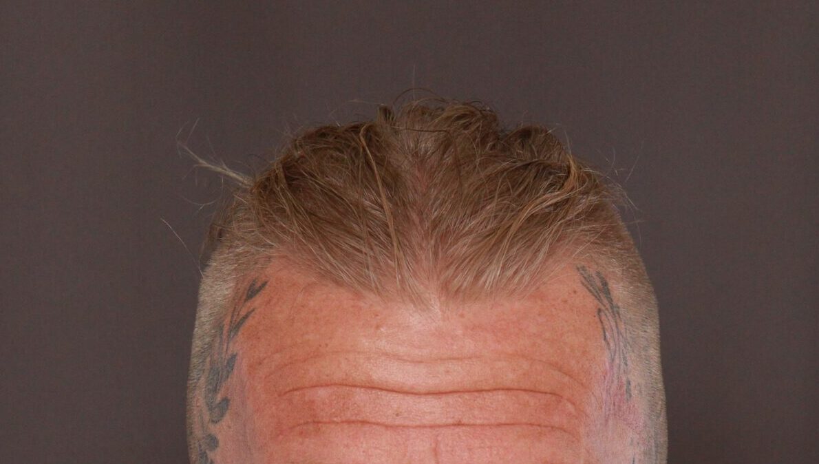 Before Image: FUT Hair Transplant by Dr. Manning - front