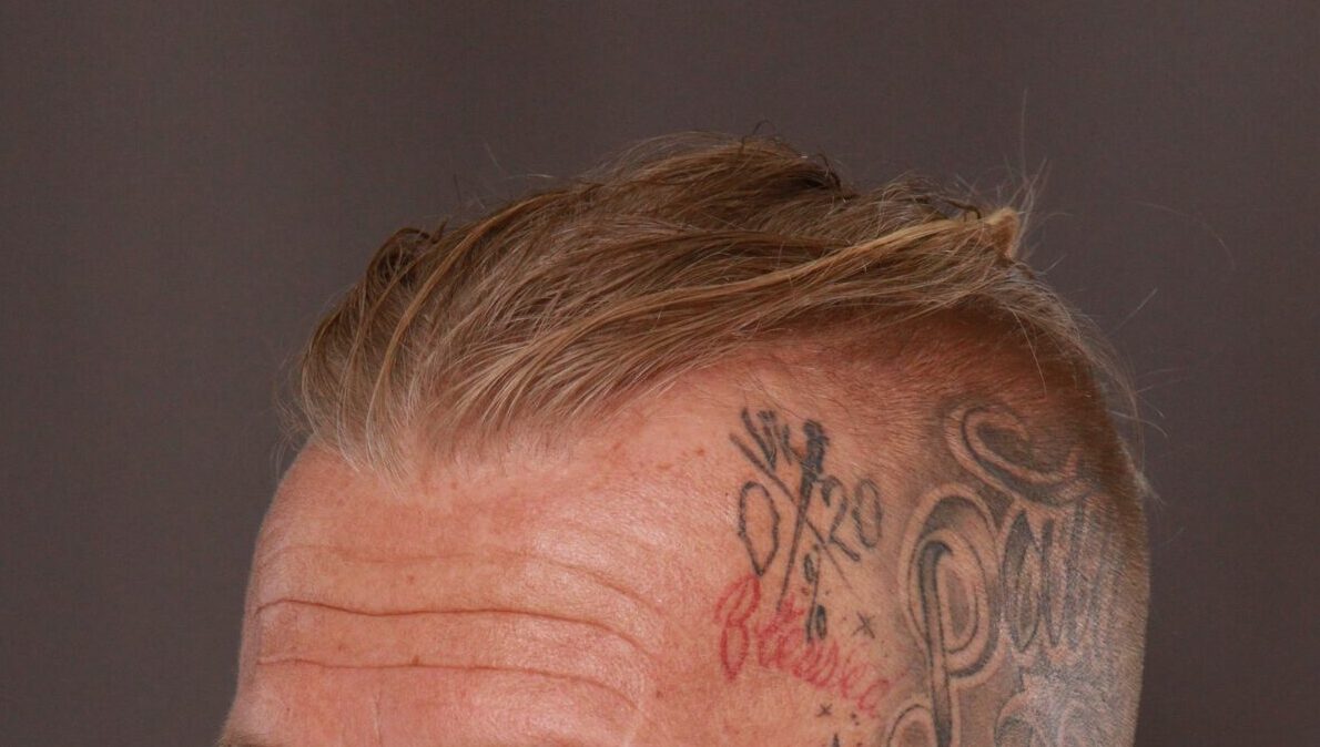 Before Image: FUT Hair Transplant by Dr. Manning - left-front-oblique