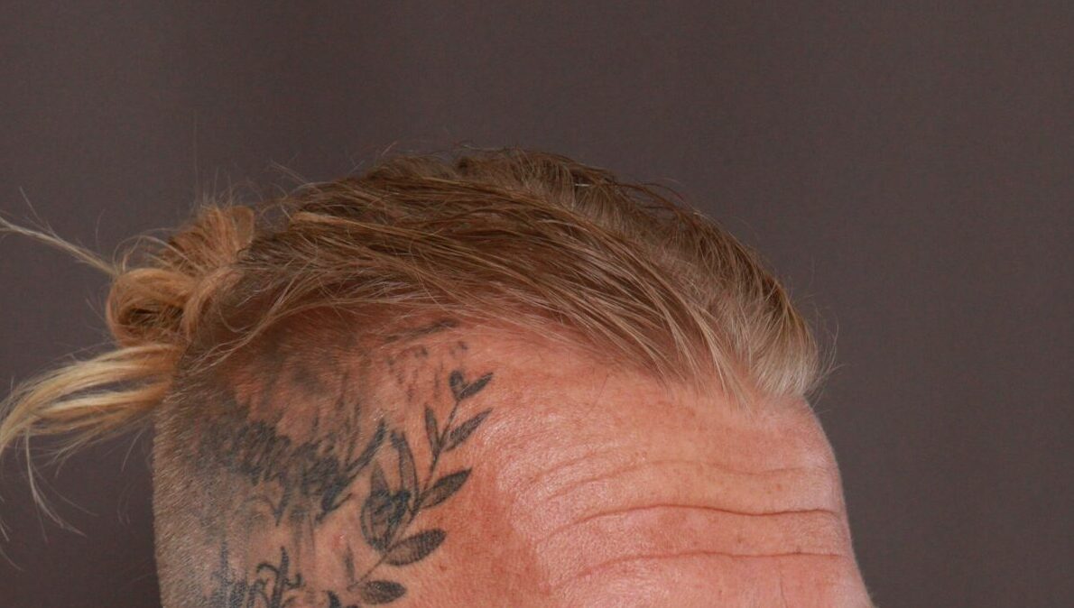 Before Image: FUT Hair Transplant by Dr. Manning - right-front-oblique