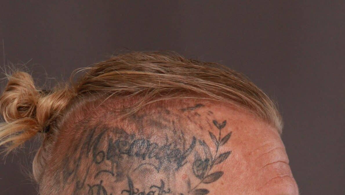 Before Image: FUT Hair Transplant by Dr. Manning - right-side