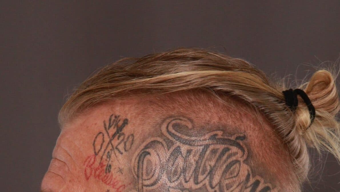 Before Image: FUT Hair Transplant by Dr. Manning - left-side