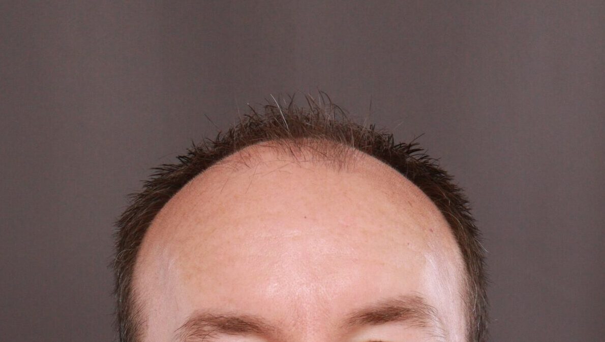 Before Image: FUE Hair Transplant by Dr. Manning - front