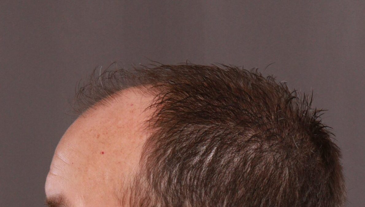 Before Image: FUE Hair Transplant by Dr. Manning - left-side