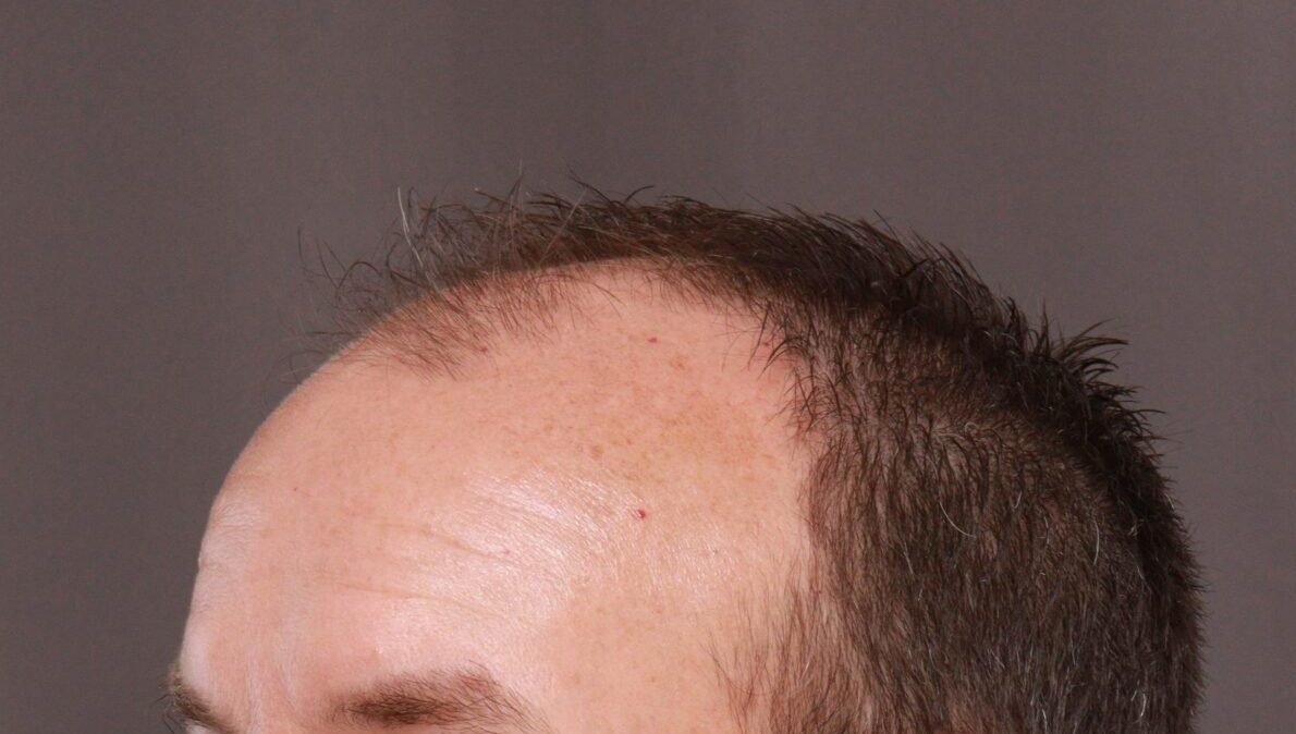 Before Image: FUE Hair Transplant by Dr. Manning - left-front-oblique