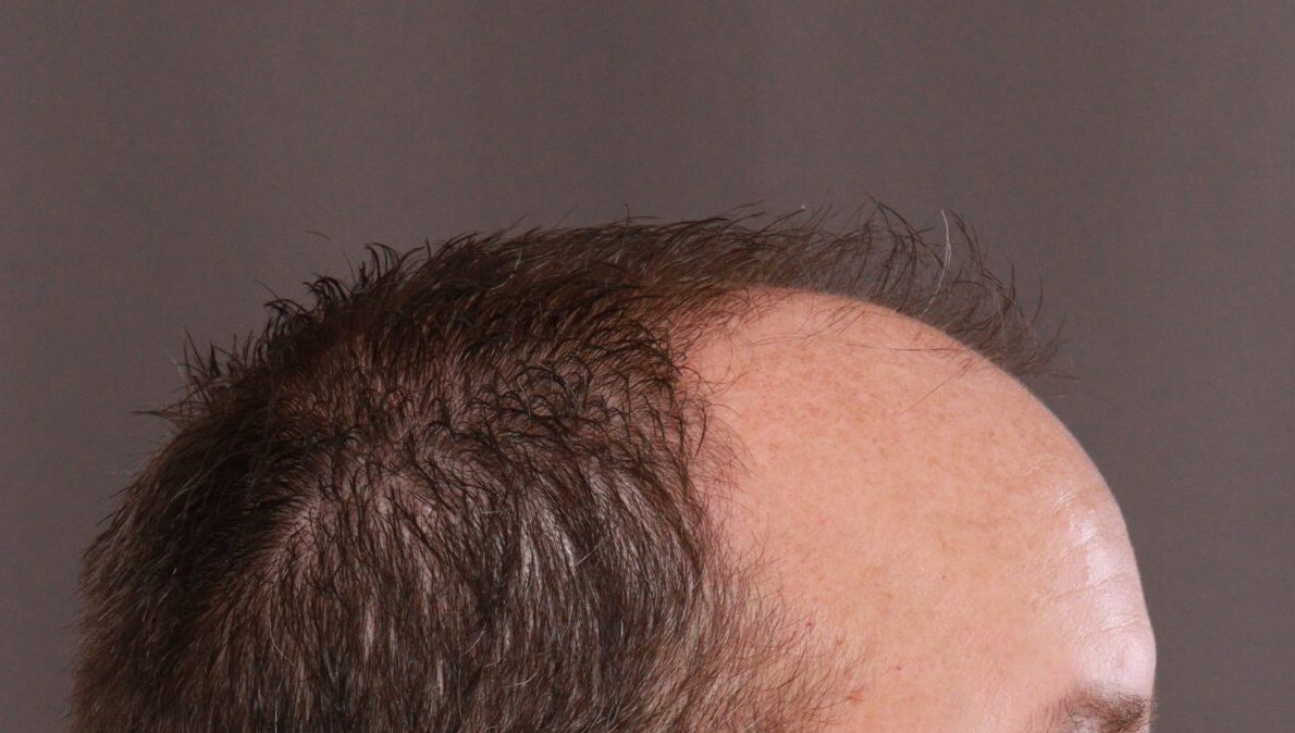 Before Image: FUE Hair Transplant by Dr. Manning - right-side