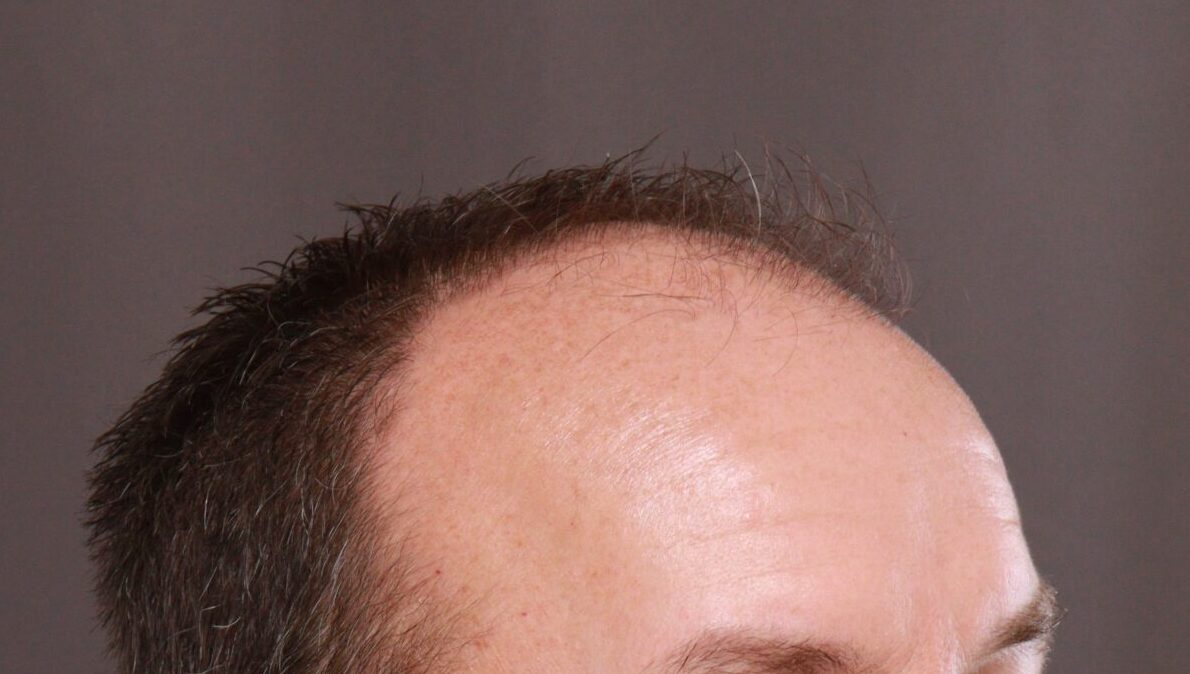 Before Image: FUE Hair Transplant by Dr. Manning - right-front-oblique