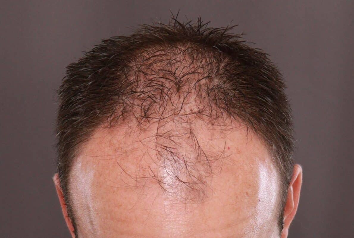 Before Image: FUE Hair Transplant by Dr. Manning - front