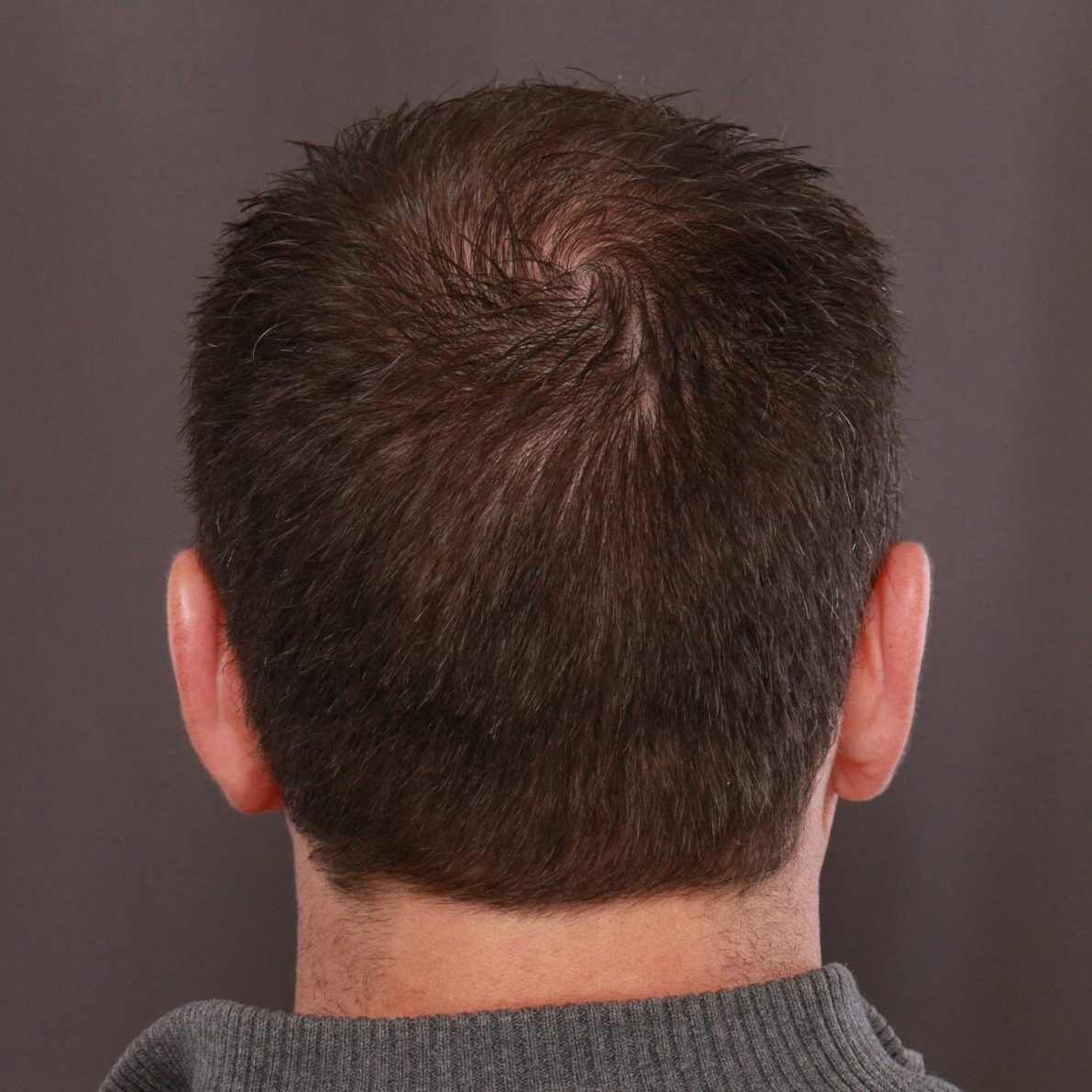 Before Image: FUE Hair Transplant by Dr. Manning - back