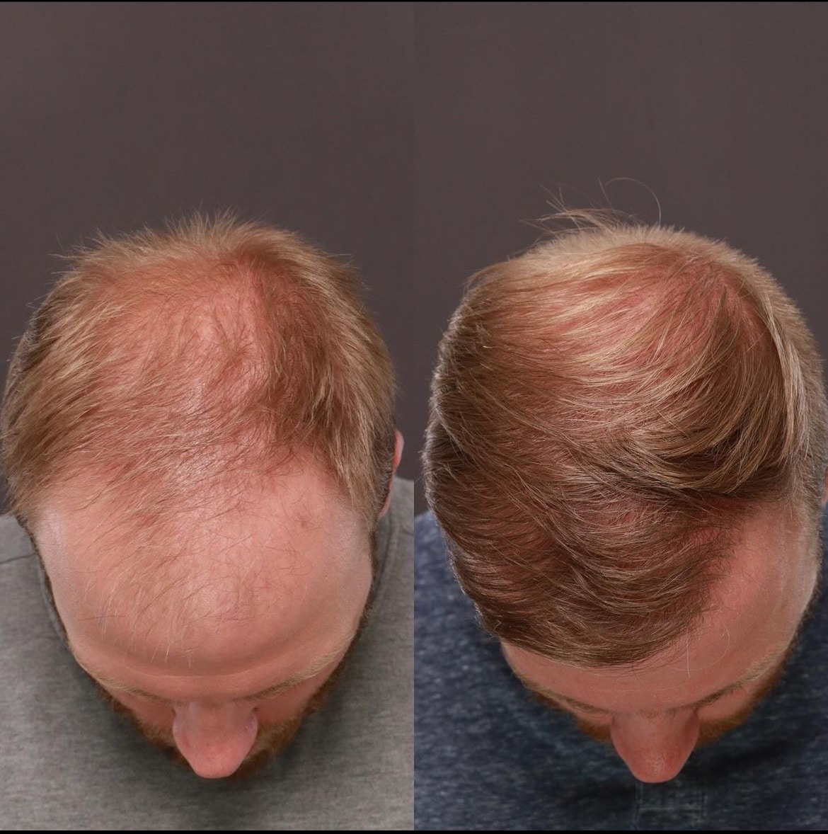 FUE4 Before after Fue transplant Roy & Draper UT 2