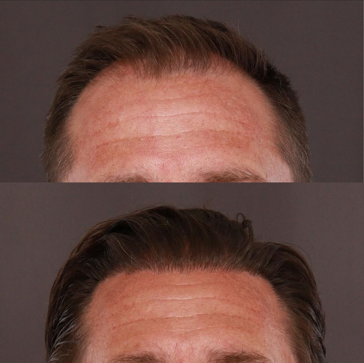 FUE6 Before after Fue transplant Roy & Draper UT