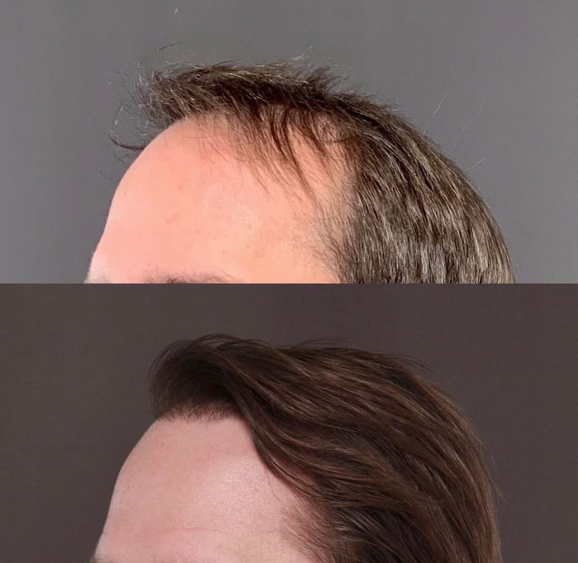 Strip method Hair Transplants Roy & Draper UT 3