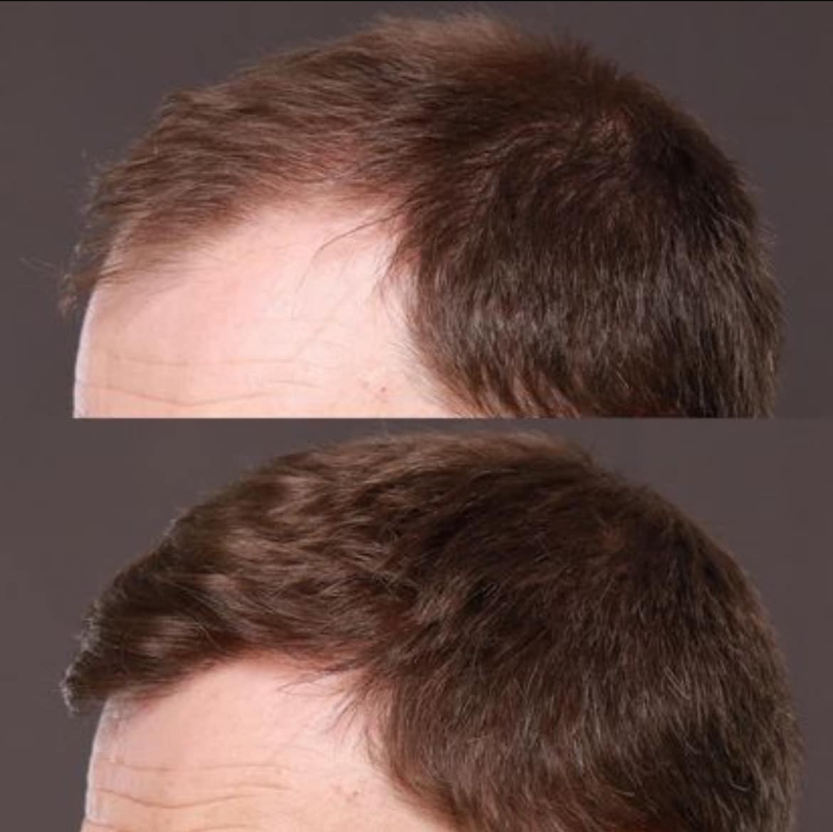 Strip method Hair Transplants Roy & Draper UT 4