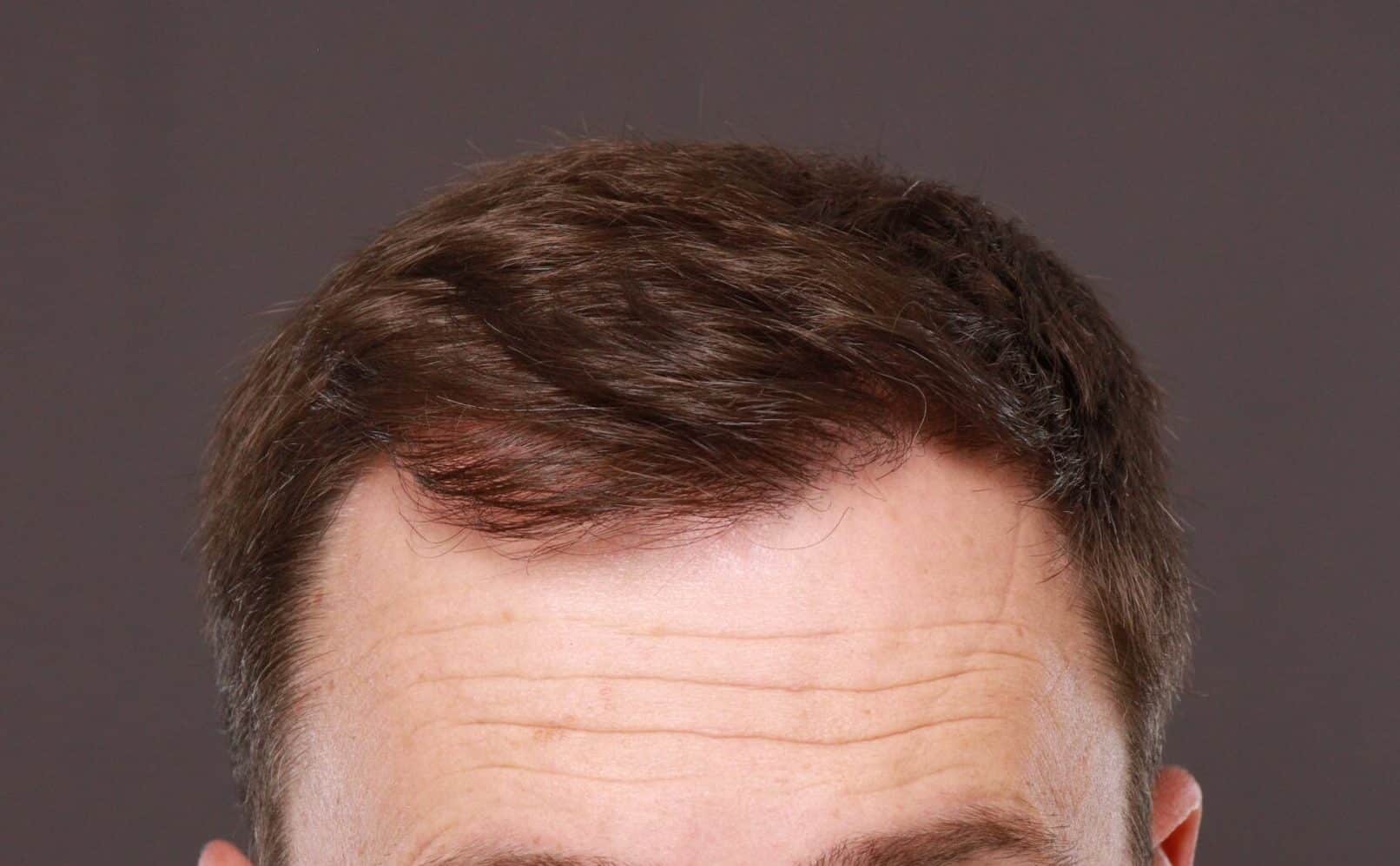 After Image: FUT Hair Transplant by Dr. Thompson - front