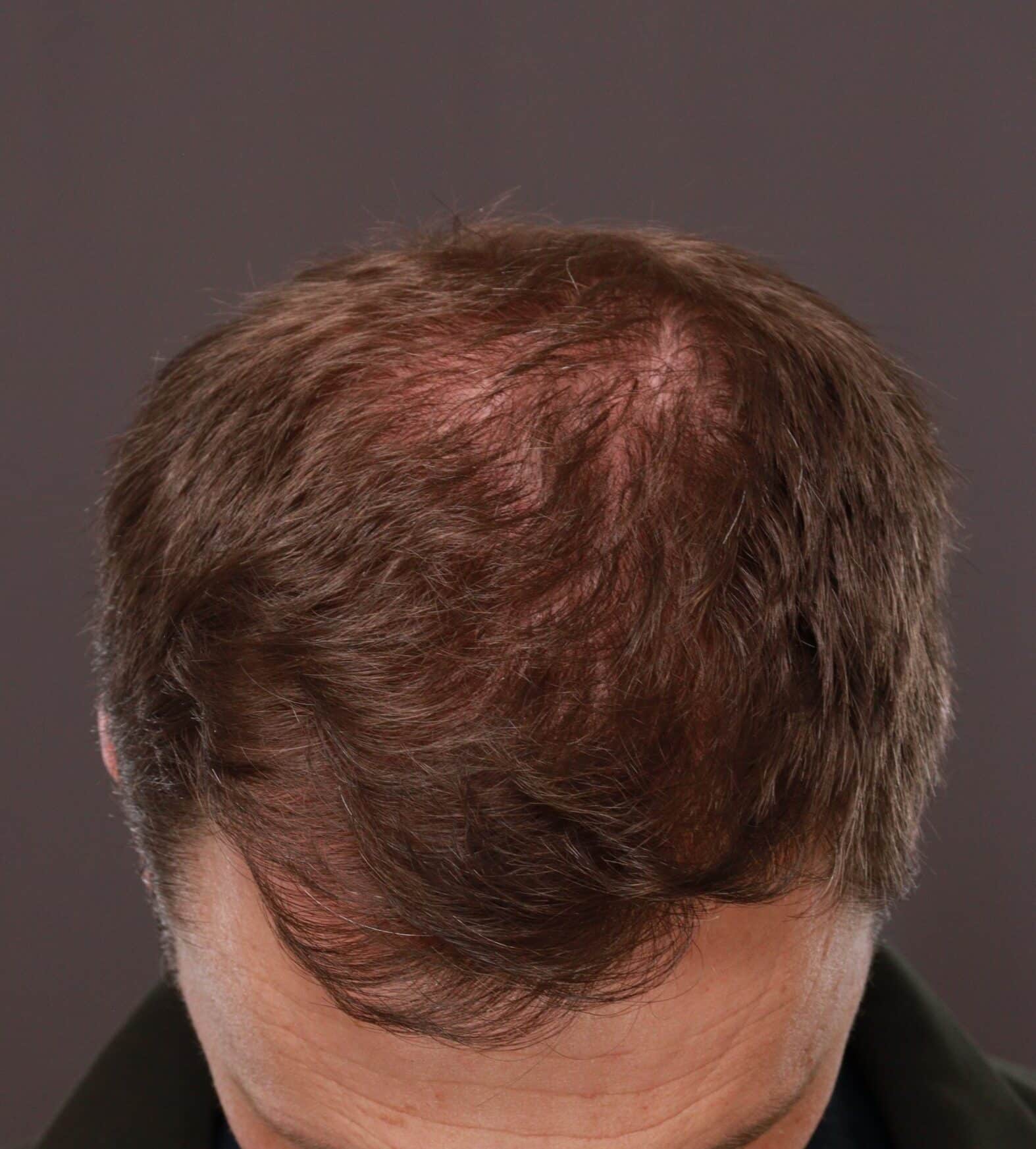 After Image: FUT Hair Transplant by Dr. Thompson - front