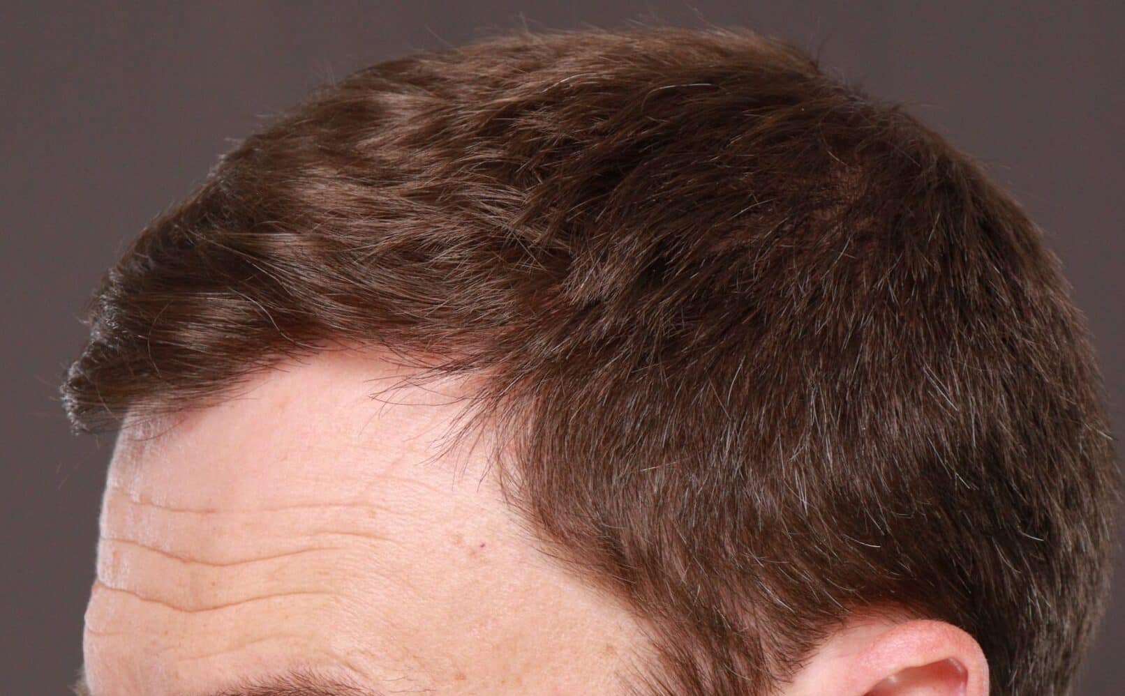 After Image: FUT Hair Transplant by Dr. Thompson - left-front-oblique