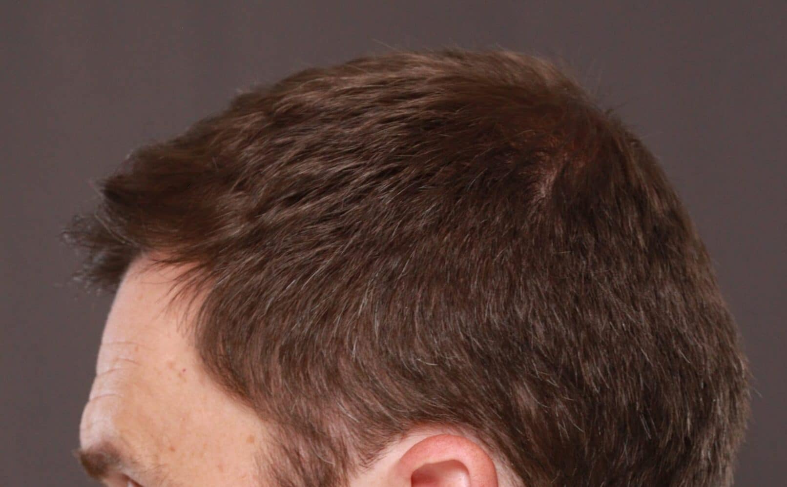 After Image: FUT Hair Transplant by Dr. Thompson - left-side