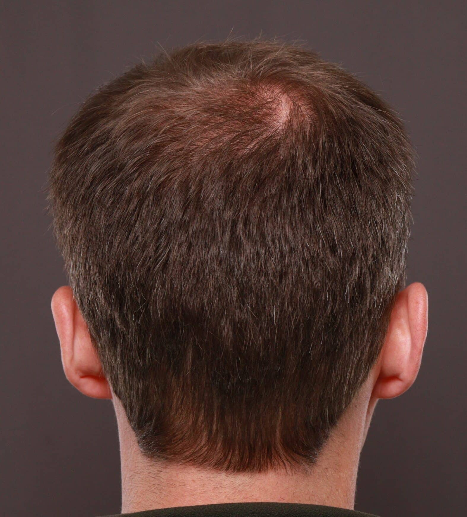 After Image: FUT Hair Transplant by Dr. Thompson - back