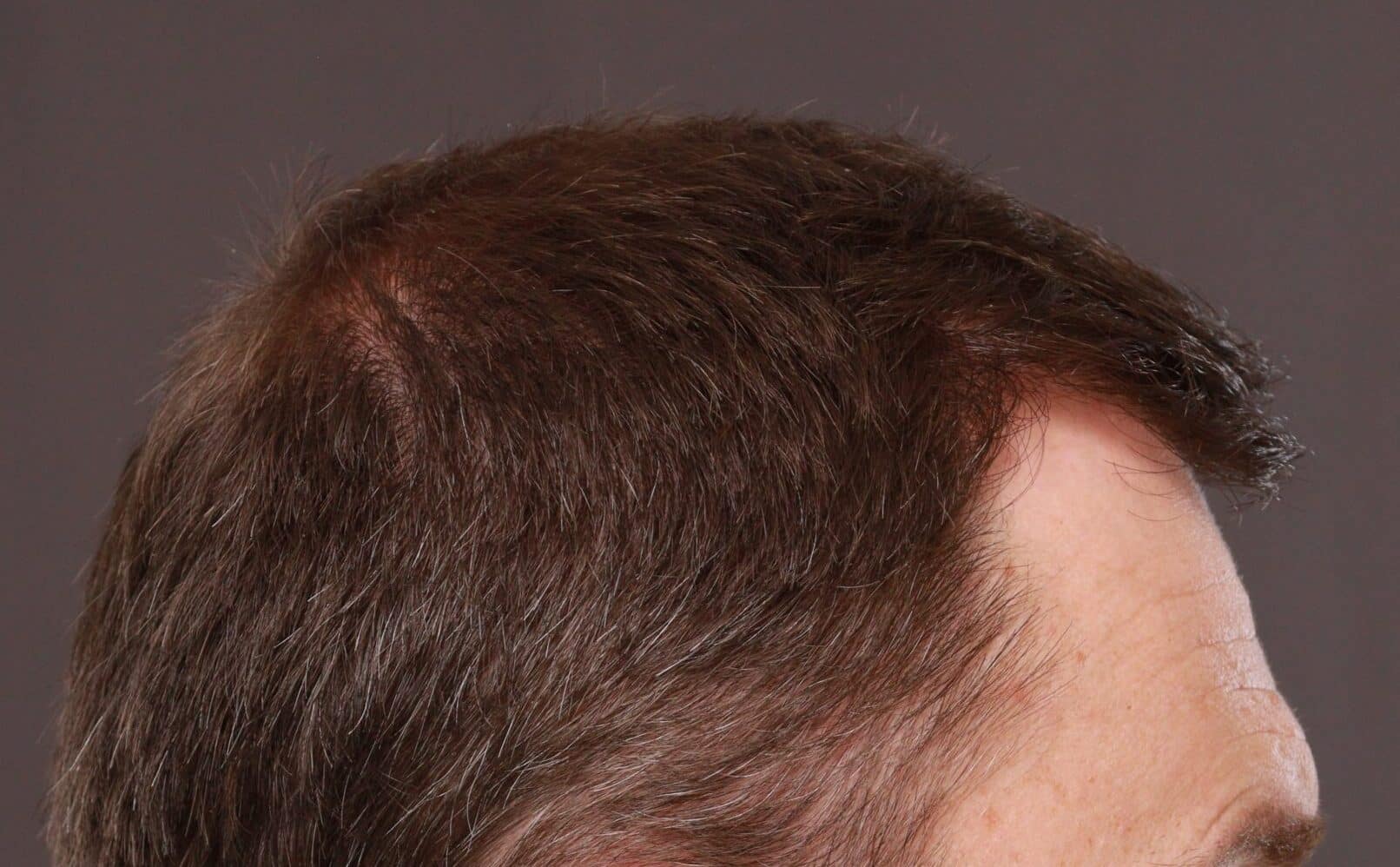 After Image: FUT Hair Transplant by Dr. Thompson - right-side