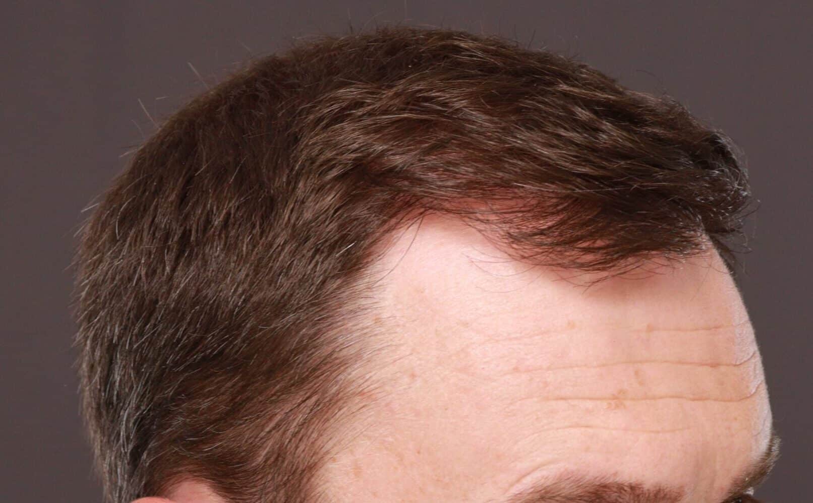 After Image: FUT Hair Transplant by Dr. Thompson - right-front-oblique