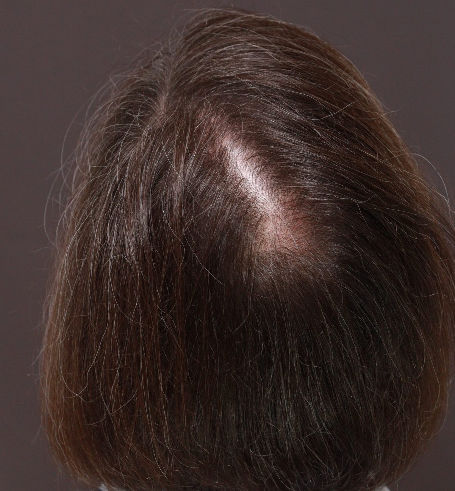 Before Image: FUT Hair Transplant by Dr. Thompson - back