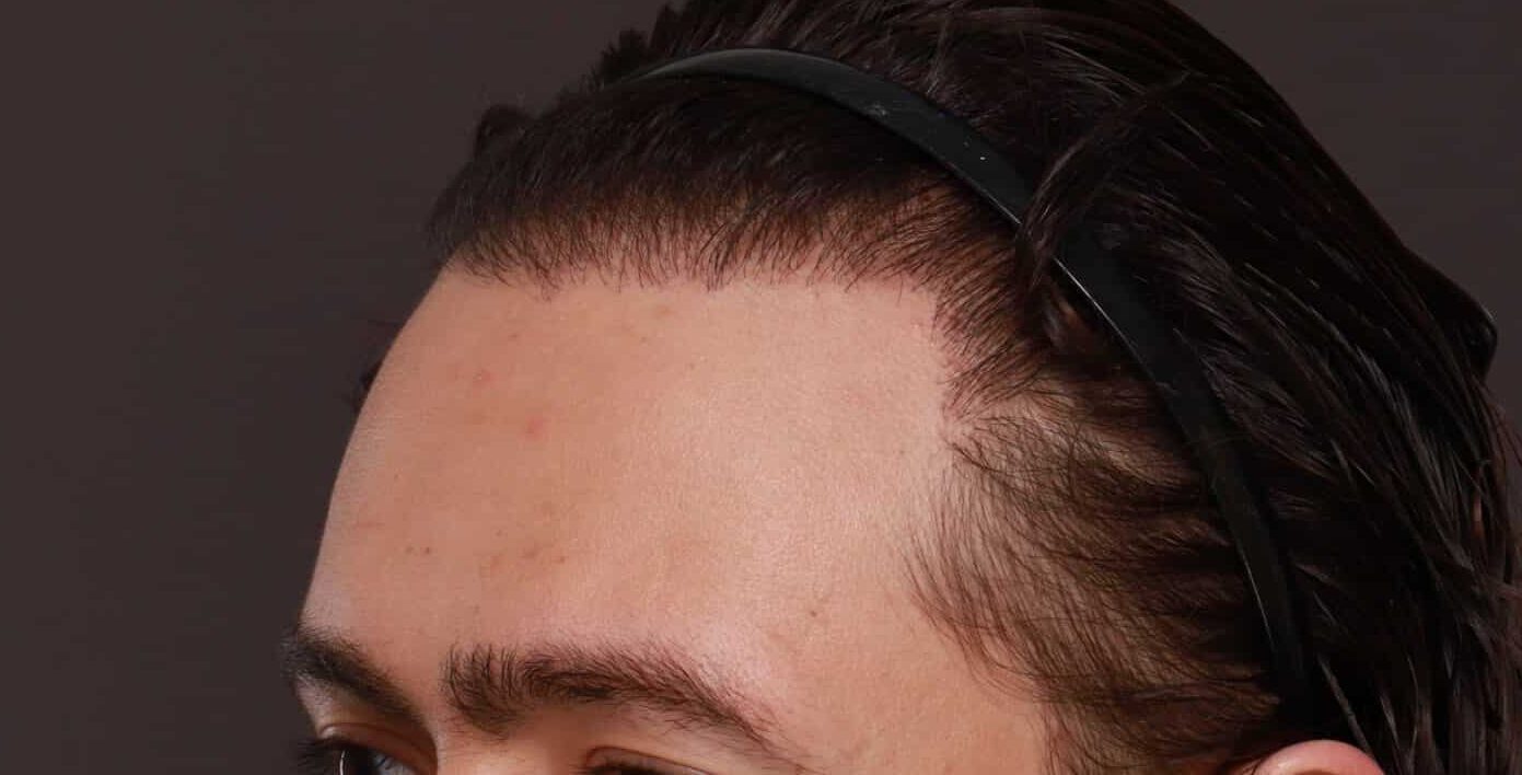 After Image: FUT Hair Transplant and Eyebrow Transplant by Dr Manning - left-front-oblique