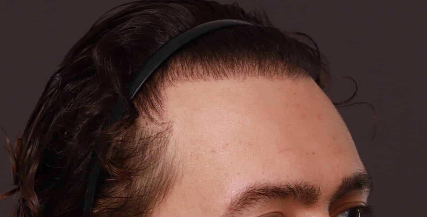 After Image: FUT Hair Transplant and Eyebrow Transplant by Dr Manning - right-front-oblique