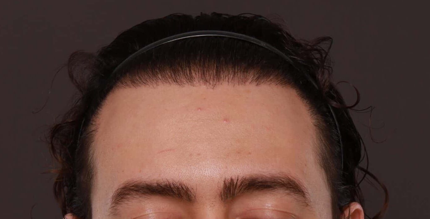 After Image: FUT Hair Transplant and Eyebrow Transplant by Dr Manning - front