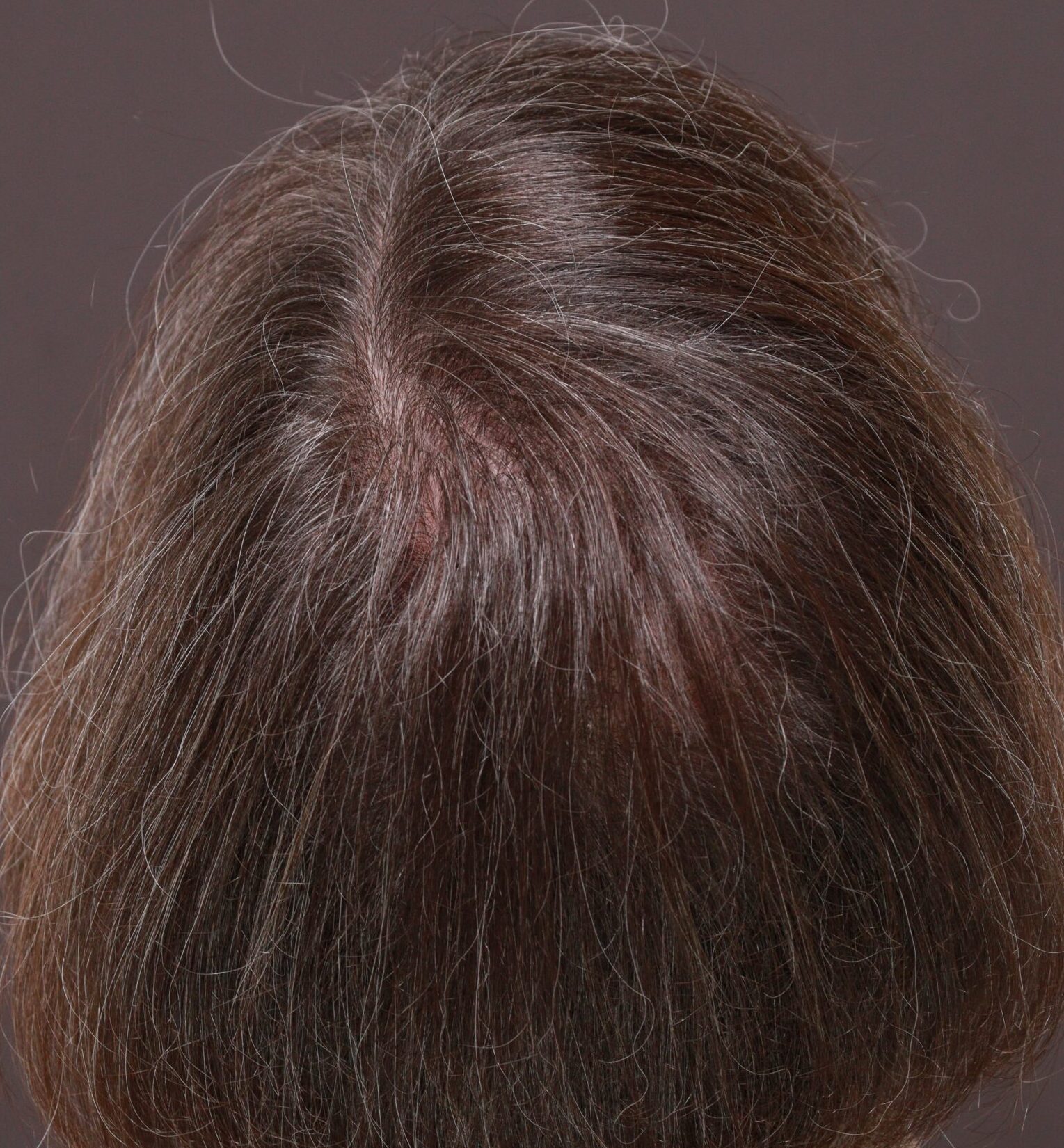 After Image: FUT Hair Transplant by Dr. Thompson - back