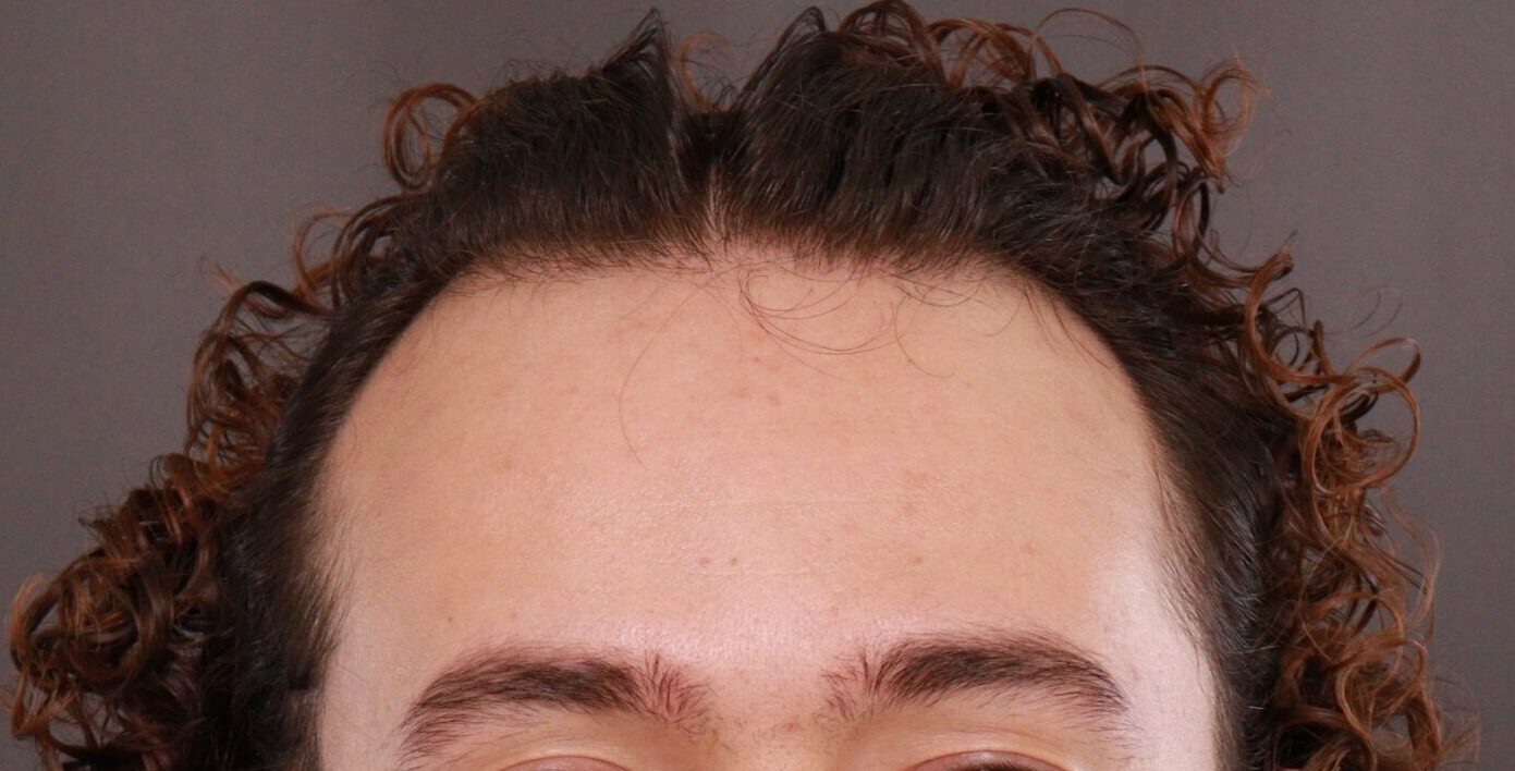 Before Image: FUT Hair Transplant and Eyebrow Transplant by Dr Manning - front