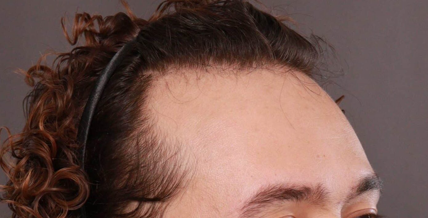 Before Image: FUT Hair Transplant and Eyebrow Transplant by Dr Manning - right-front-oblique