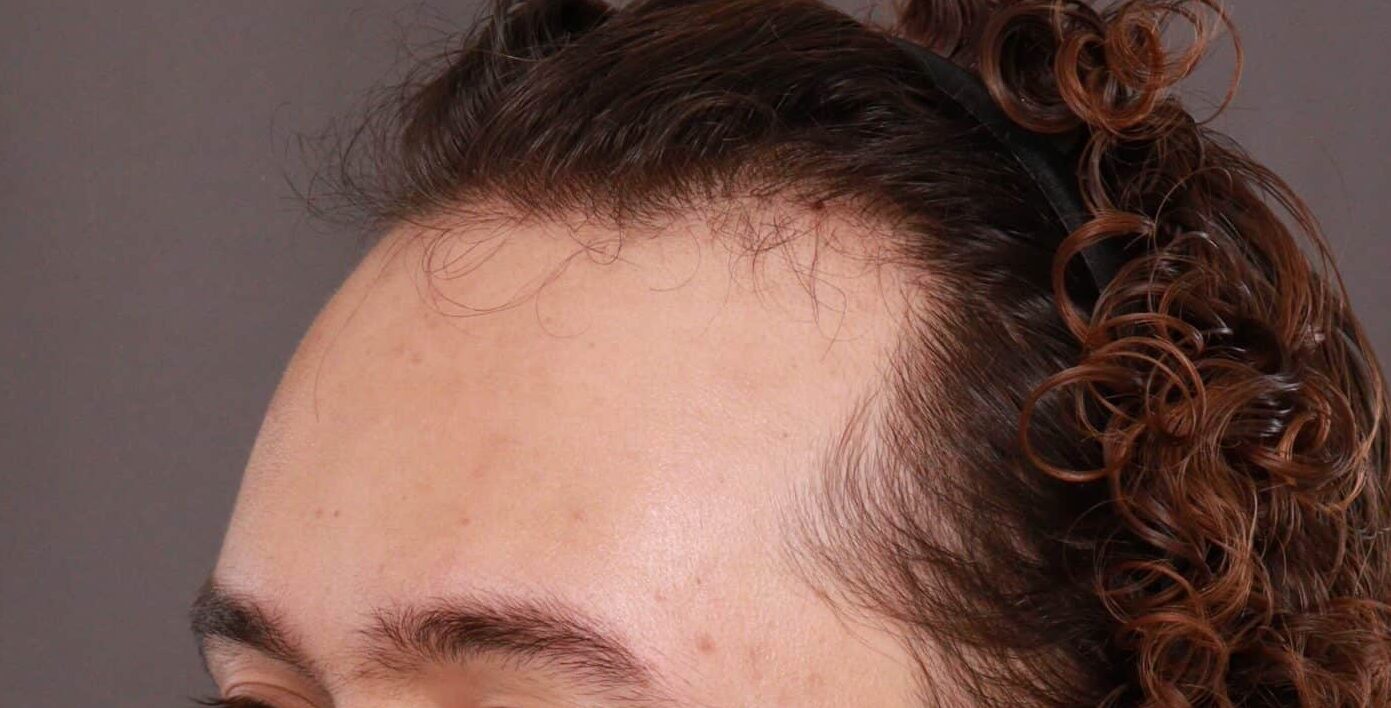 Before Image: FUT Hair Transplant and Eyebrow Transplant by Dr Manning - left-front-oblique