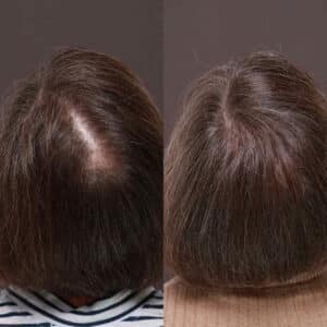 female hair transplant female hair transplant Roy & Draper UT