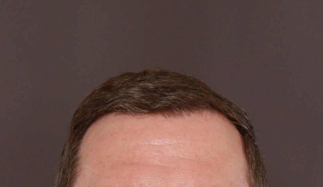 After Image: FUE Hair Transplant by Dr. Manning - front