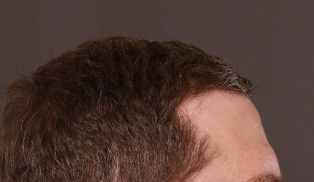 After Image: FUE Hair Transplant by Dr. Manning - right-side