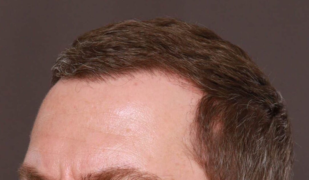 After Image: FUE Hair Transplant by Dr. Manning - front