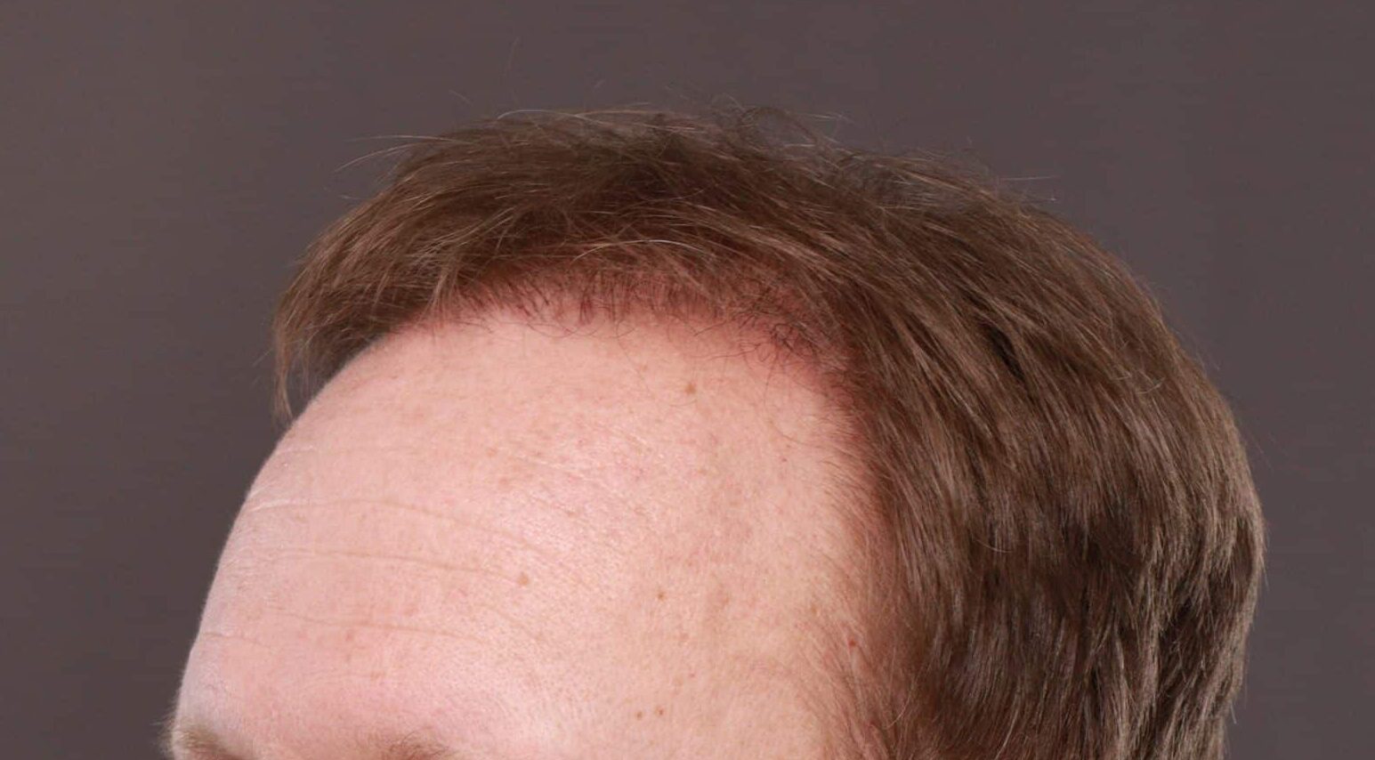 After Image: FUE Hair Transplant by Dr. Thompson - left-front-oblique
