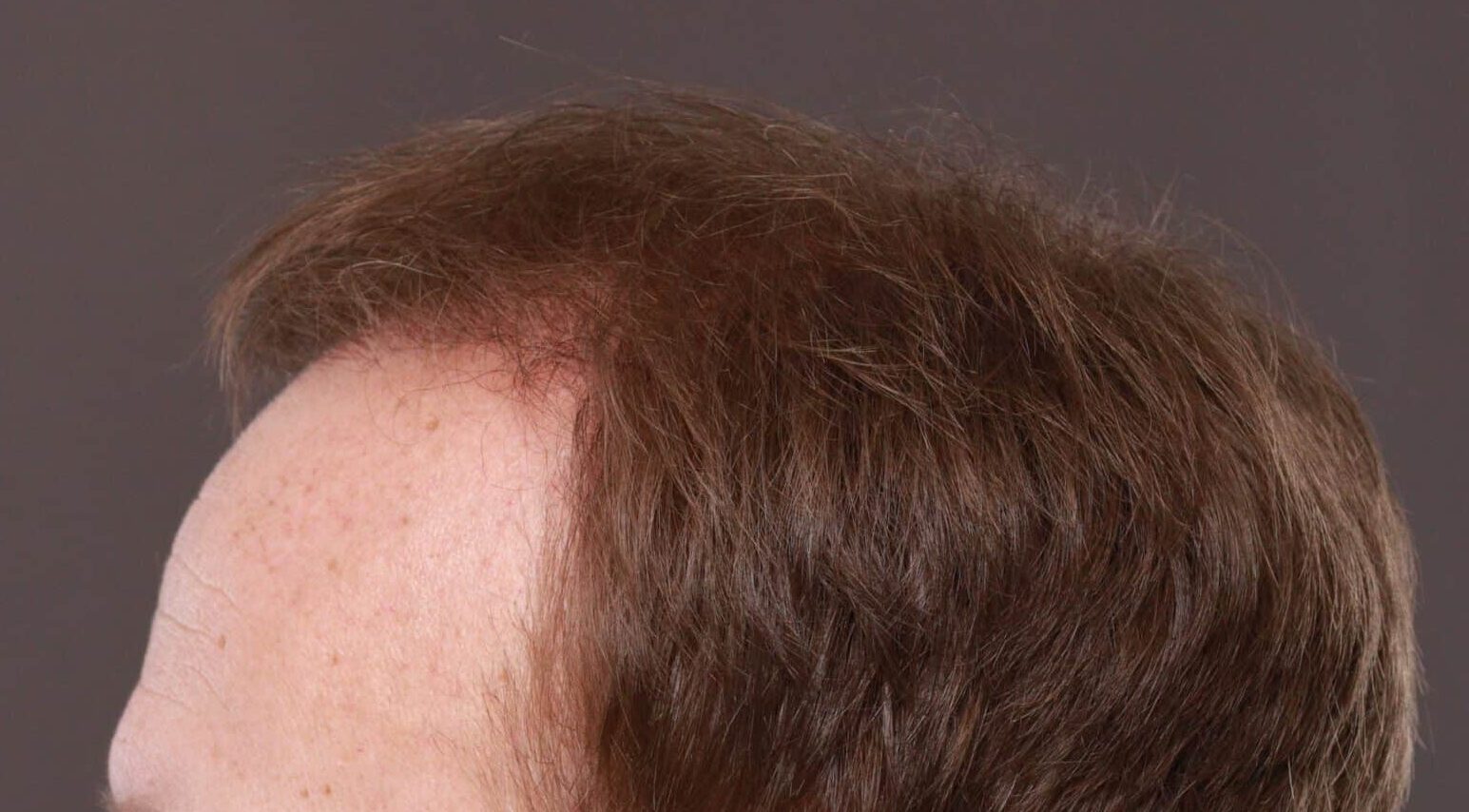 After Image: FUE Hair Transplant by Dr. Thompson - left-side