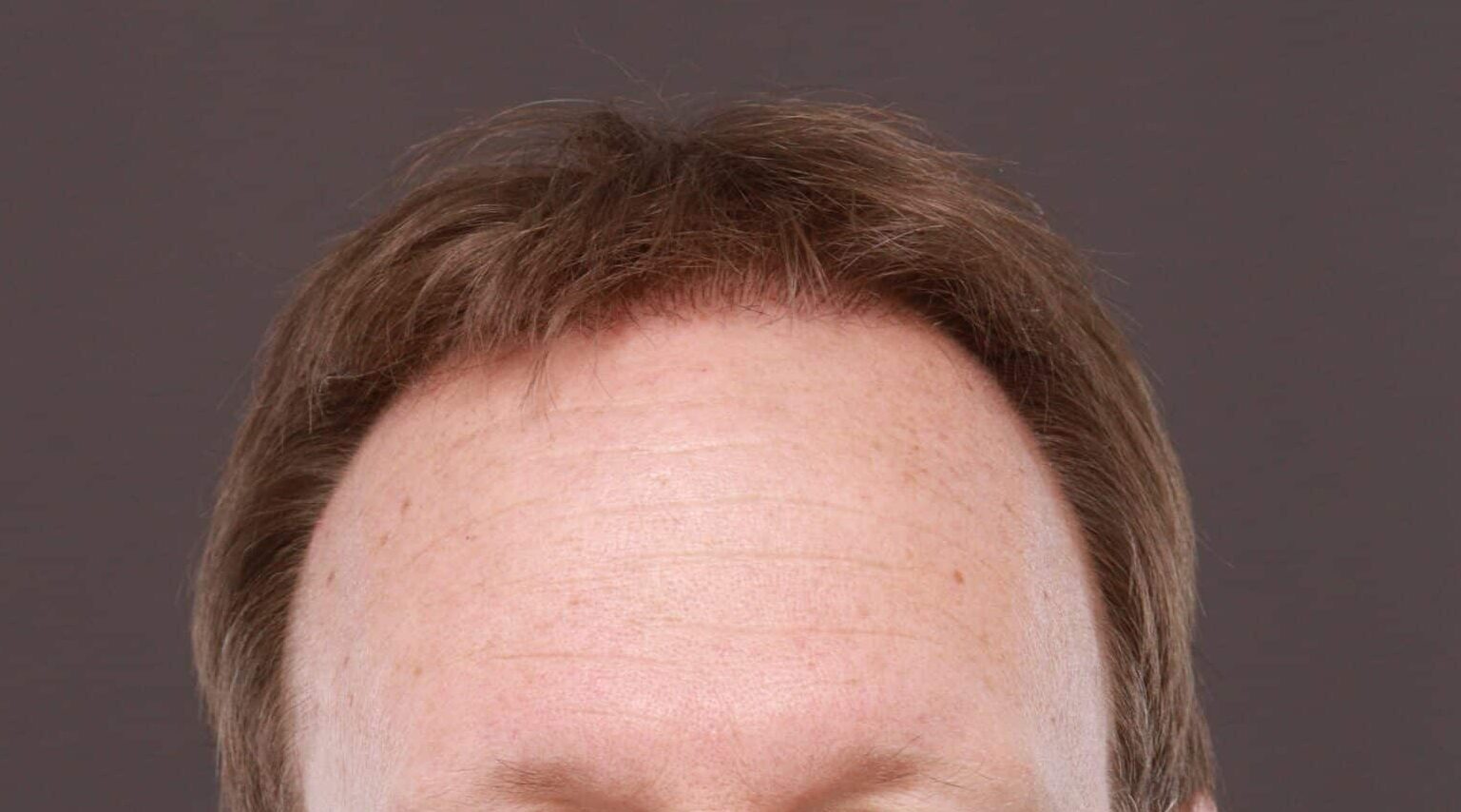 After Image: FUE Hair Transplant by Dr. Thompson - front
