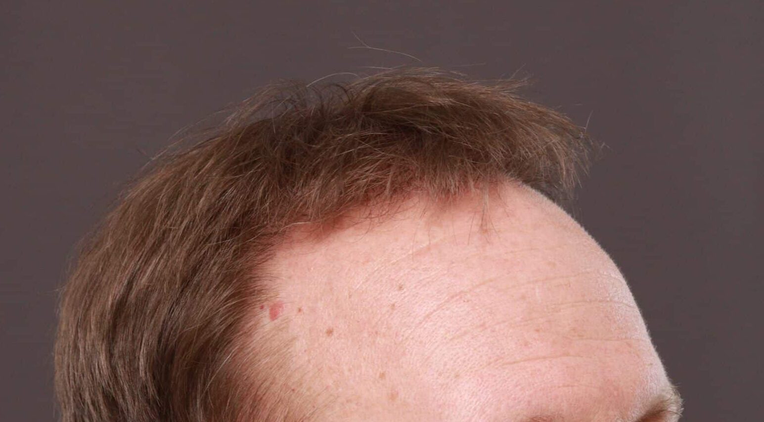 After Image: FUE Hair Transplant by Dr. Thompson - right-side