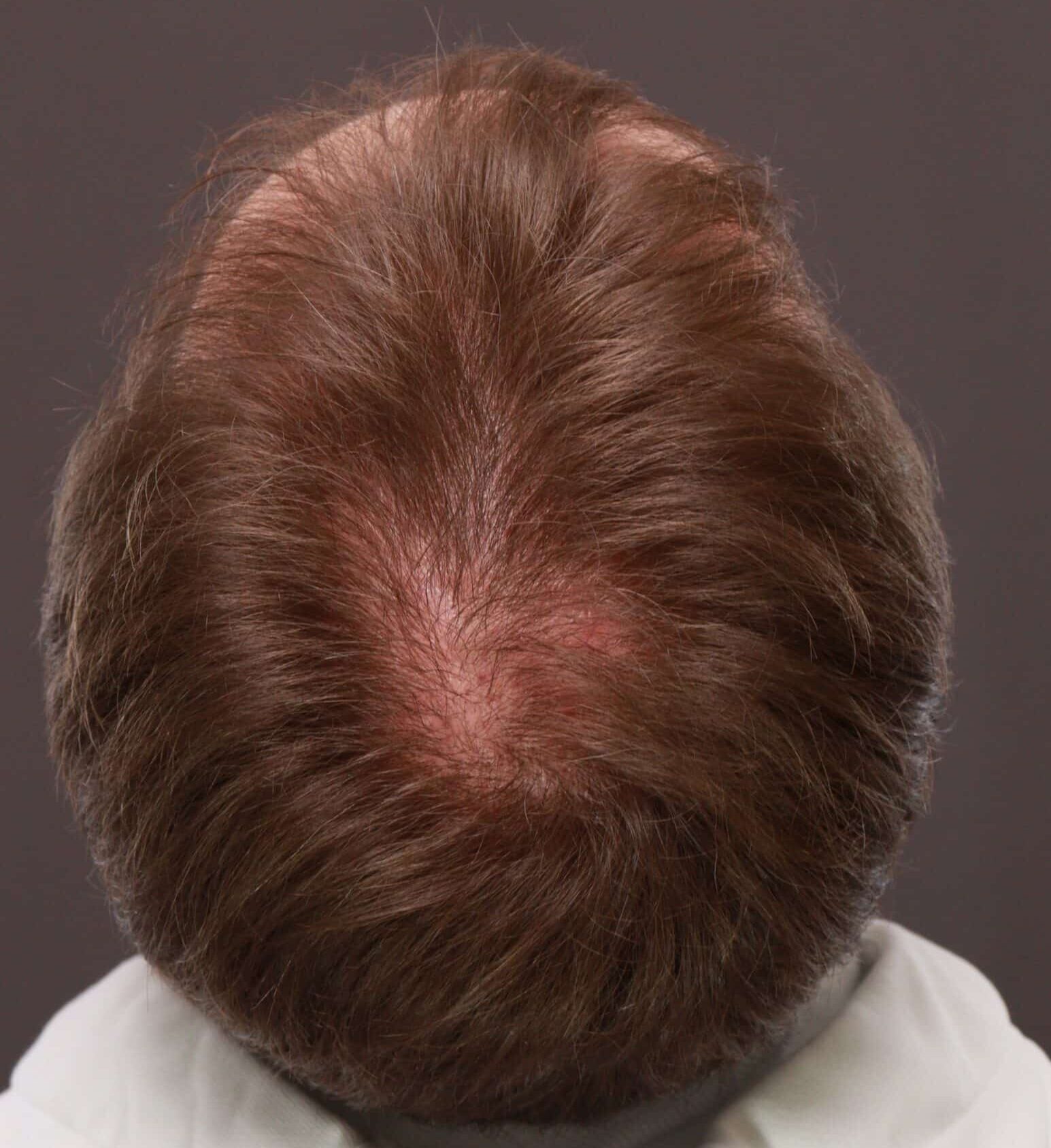 After Image: FUE Hair Transplant by Dr. Thompson - back