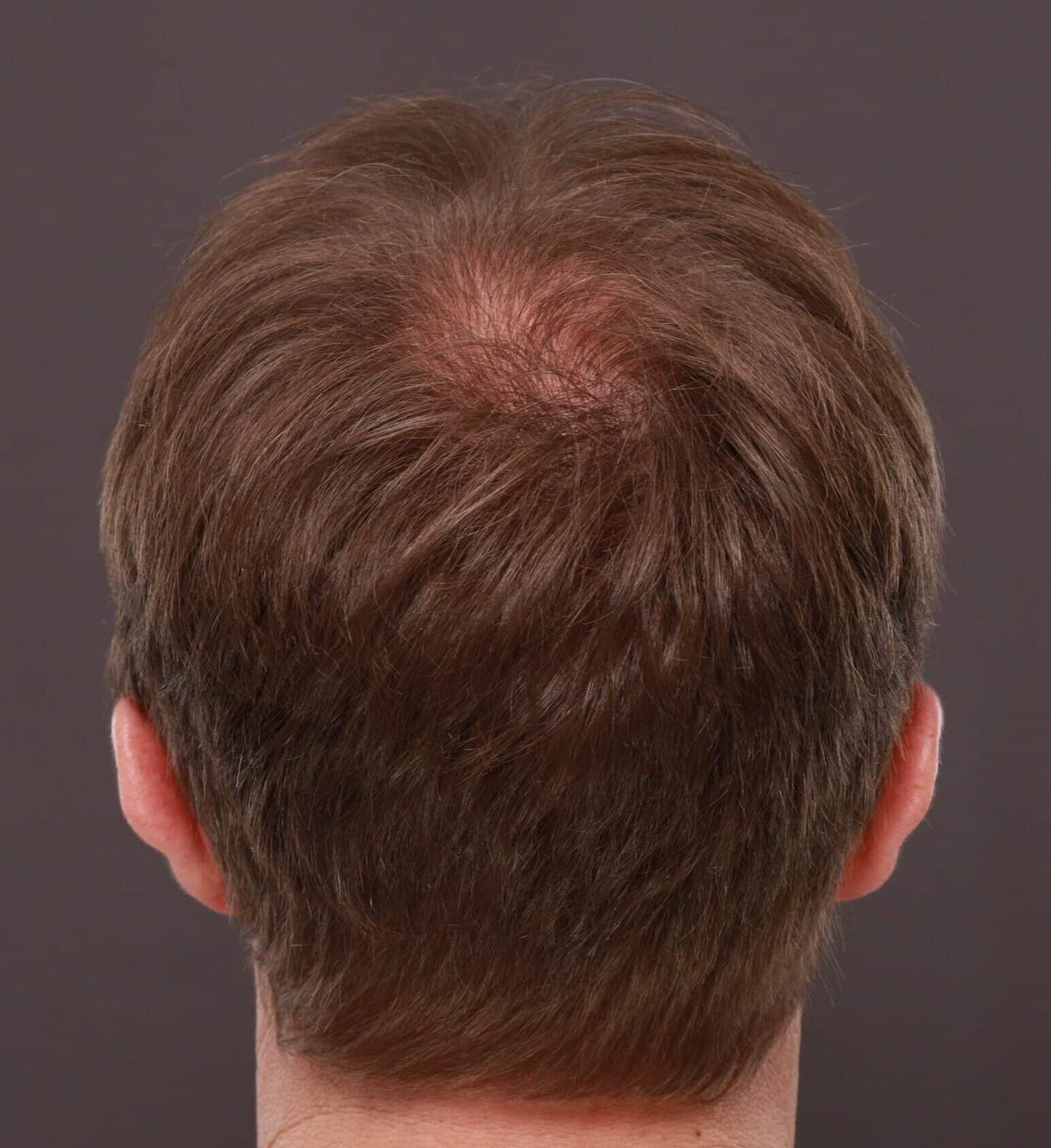 After Image: FUE Hair Transplant by Dr. Thompson - 