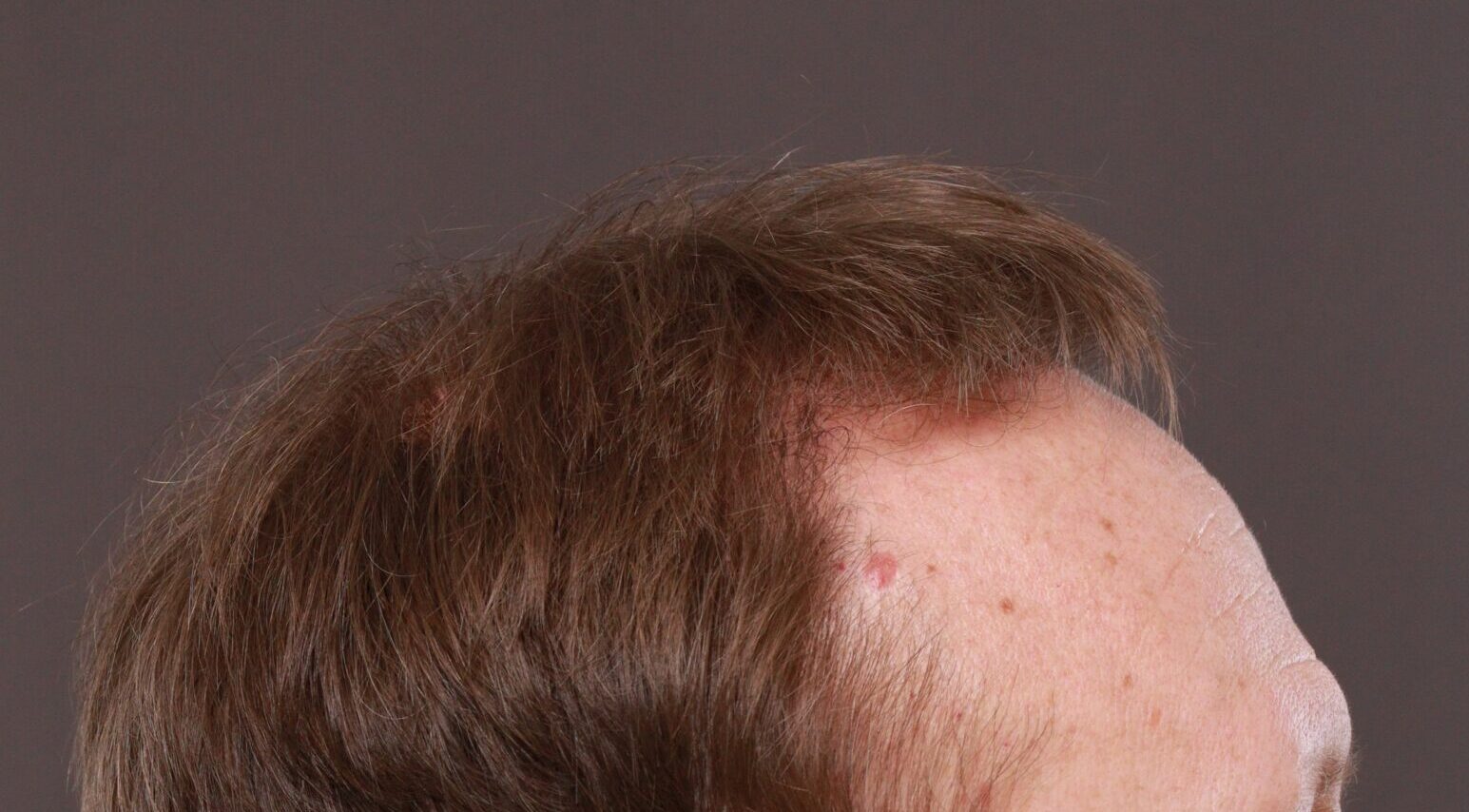 After Image: FUE Hair Transplant by Dr. Thompson - right-side
