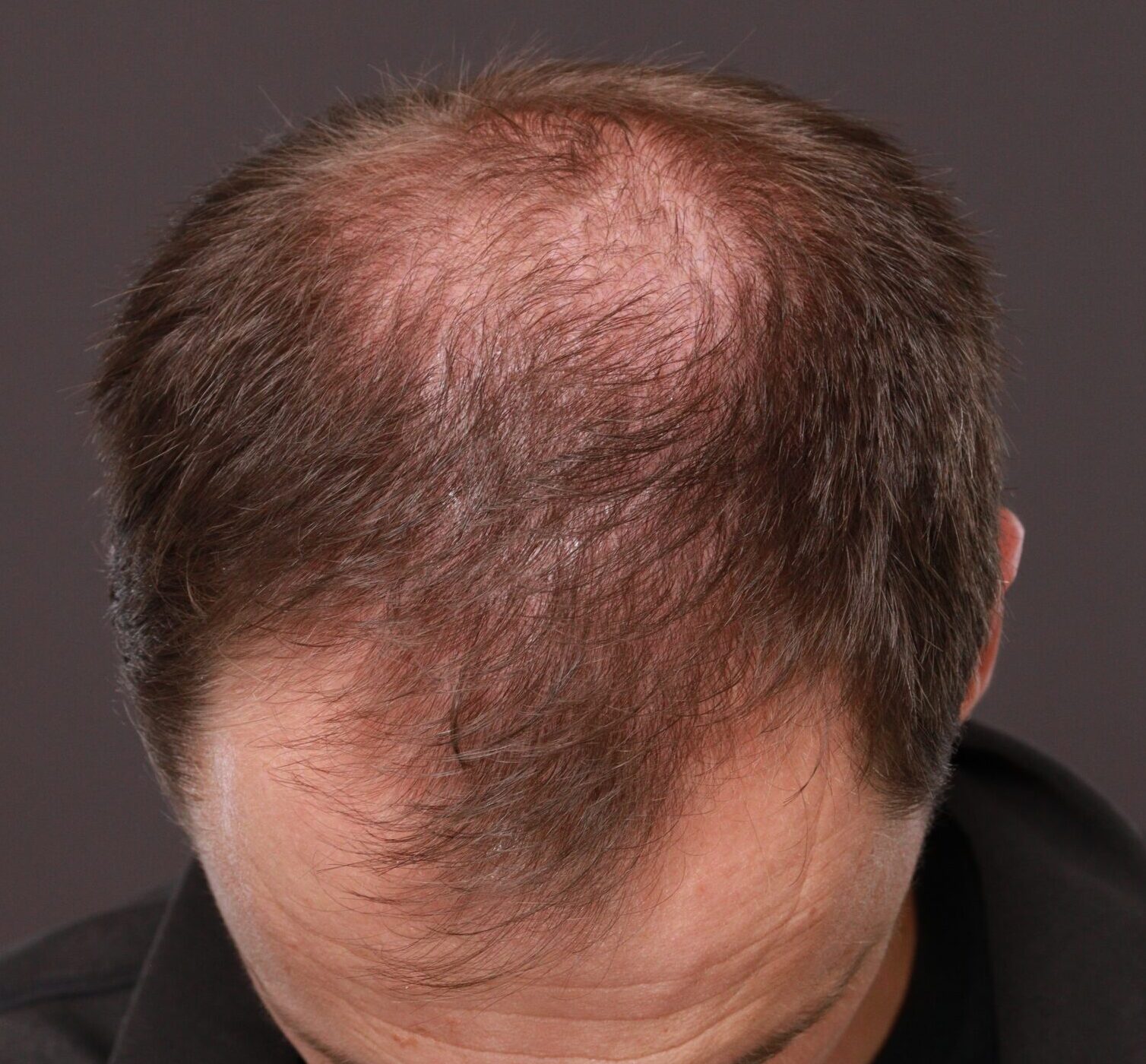 Before Image: FUT Hair Transplant by Dr. Thompson - front