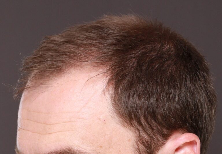 Before Image: FUT Hair Transplant by Dr. Thompson - left-front-oblique