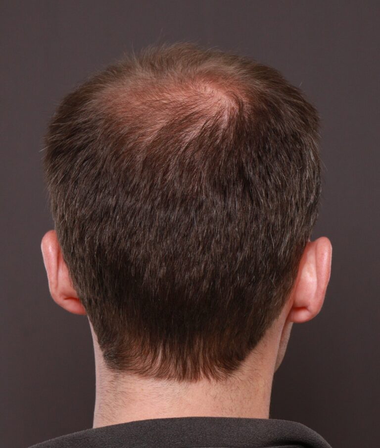 Before Image: FUT Hair Transplant by Dr. Thompson - front