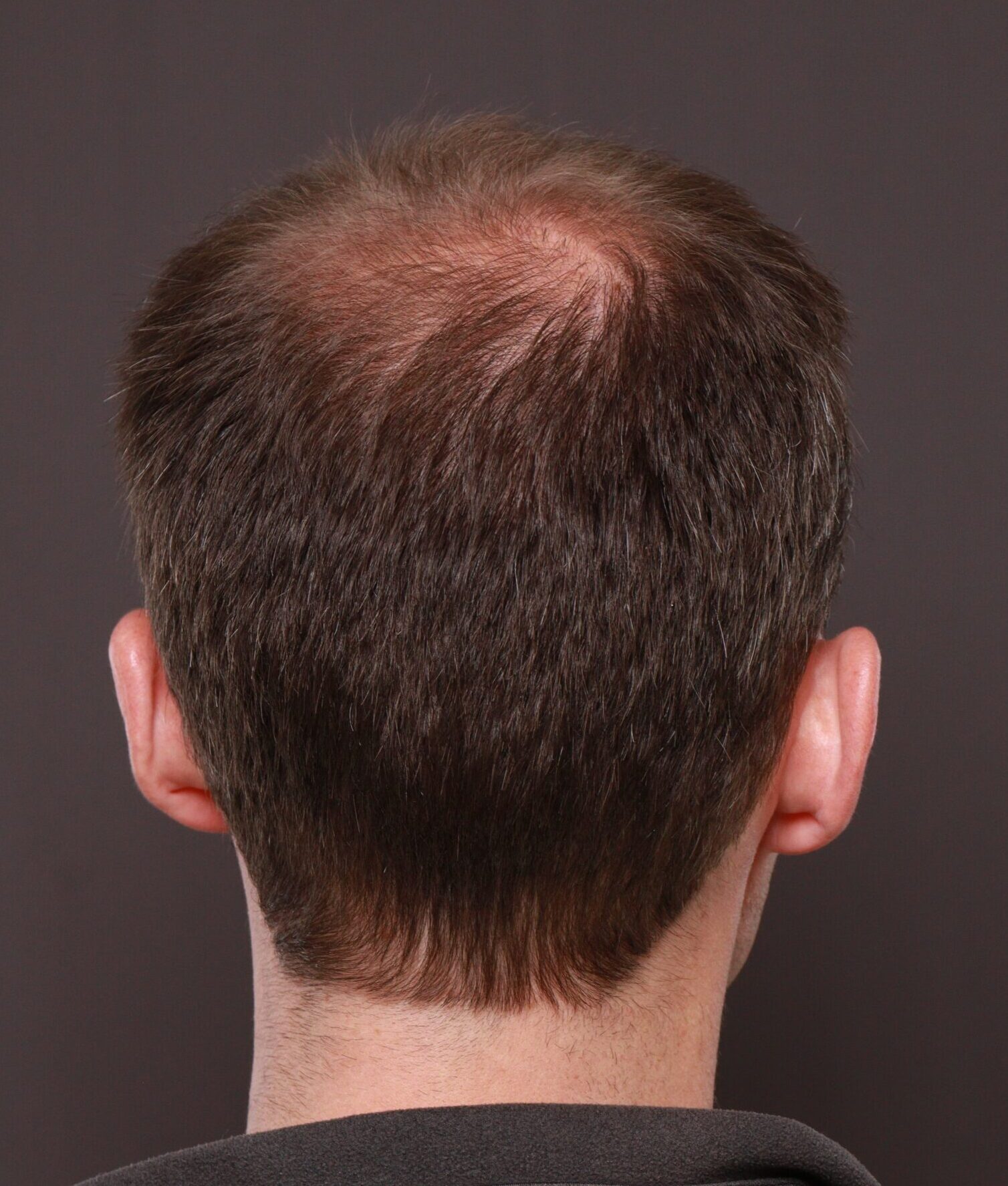 Before Image: FUT Hair Transplant by Dr. Thompson - front
