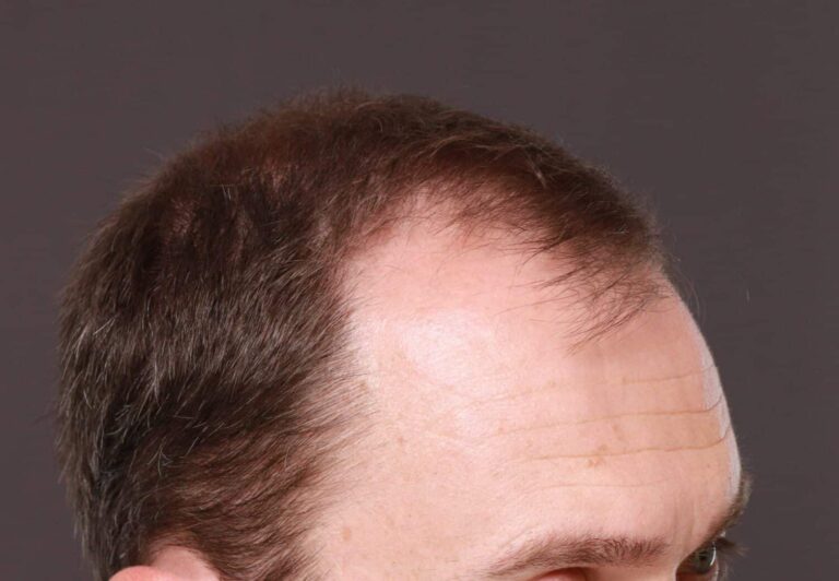 Before Image: FUT Hair Transplant by Dr. Thompson - right-front-oblique